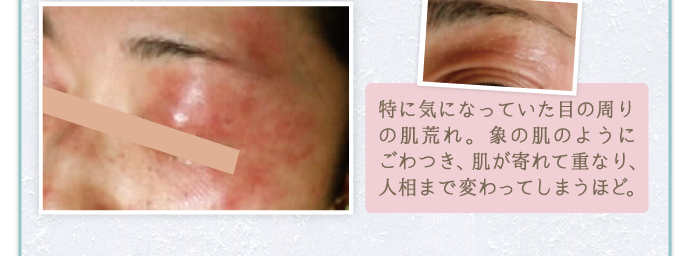 特に気になっていた目の周りの肌荒れ。象のようにごわつき、肌が寄れて重なり、人相まで変わってしまうほど。