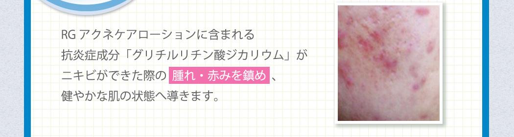 RGアクネケアローションに含まれる抗炎症成分「グリチルリチン酸ジカリウム」がニキビができた際の腫れ・赤みを鎮め、健やかな肌の状態へ導きます。