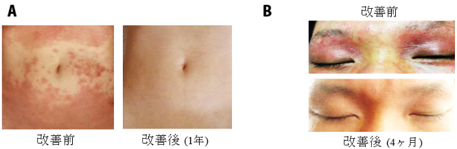 図２ 温泉スキンケア(OMB法)による改善例