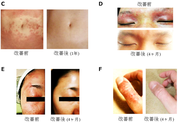 C) スキンケアが奏功した例　（使用期間：1年）